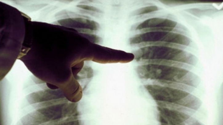 Gripa impune restricţii la Spitalul de Pneumoftiziologie Satu Mare