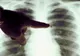 Gripa impune restricţii la Spitalul de Pneumoftiziologie Satu Mare