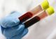Un nou test de sânge ar putea revoluționa diagnosticul de cancer